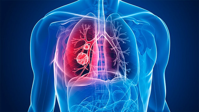  La contaminación ambiental, infecciones de las vías respiratorias, el tabaquismo, entre las afecciones que más comprometen la salud pulmonar