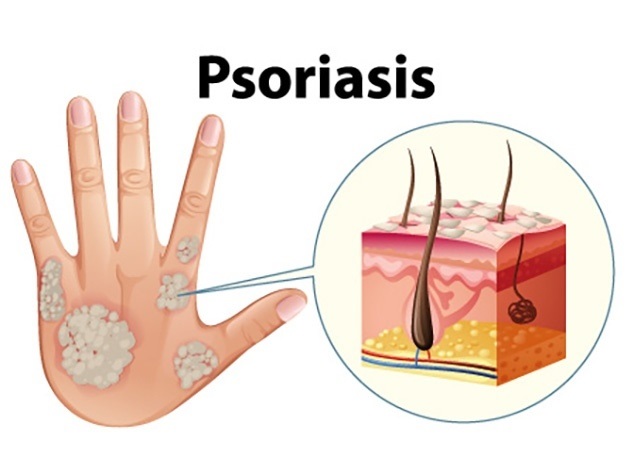  Psoriasis afecta tanto la piel, como la parte emocional de quienes la padecen