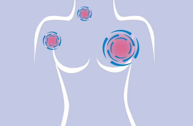 Las mujeres deben saber sobre su riesgo de cáncer de mama