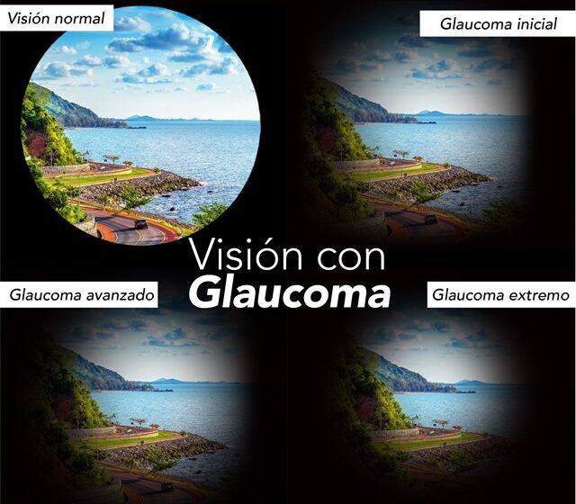  Hoy se conmemora el Día Mundial del Glaucoma